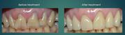 Get the dental implant restoration treatment at Ashton Avenue Dental
