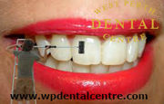 Best-Teeth Cleaning -And–Teeth Whitening -in west Perth- Dental Centre