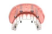Cosmetic Dental Implants Surgery in Penrith
